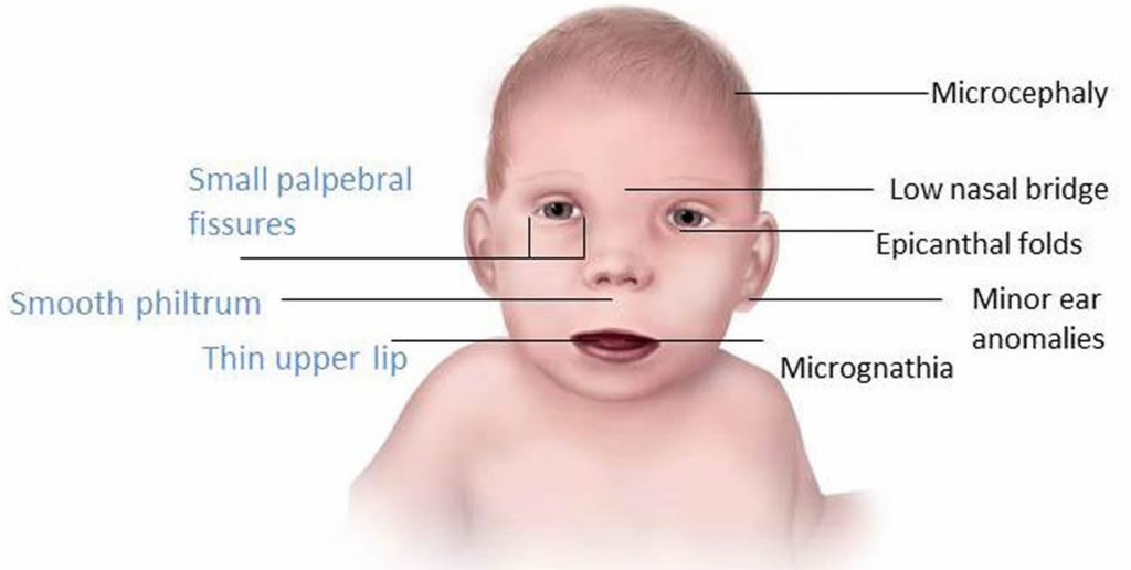 case study fetal alcohol syndrome