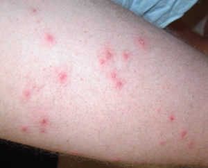 Folliculitis - Causes, Signs, Symptoms, How to Get Rid of Folliculitis