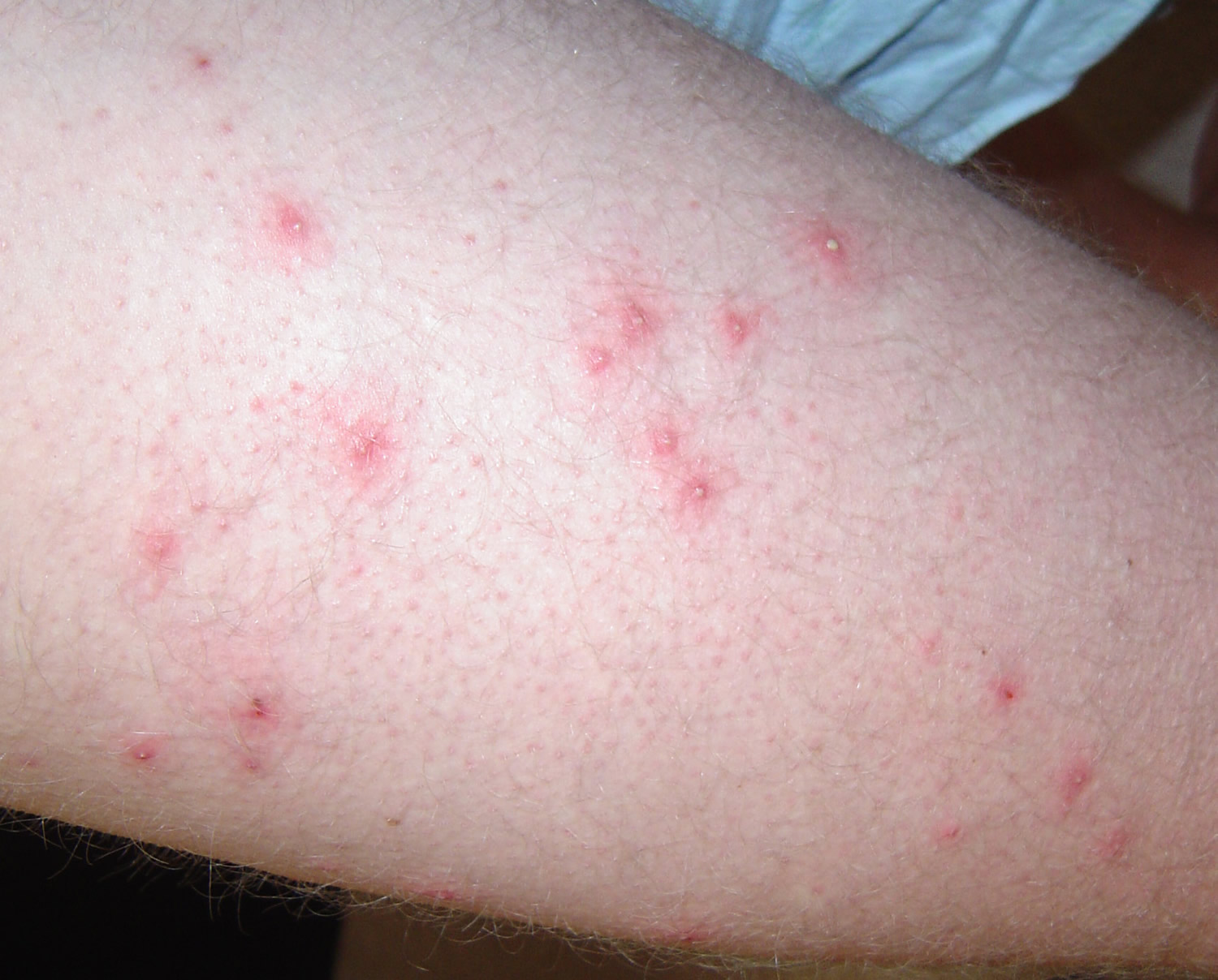 foliculitis