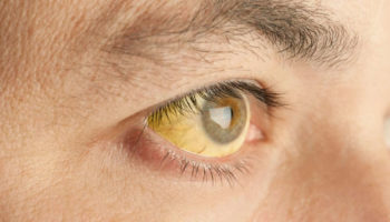 Gilbert syndrome