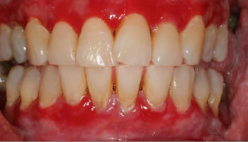 gingivitis