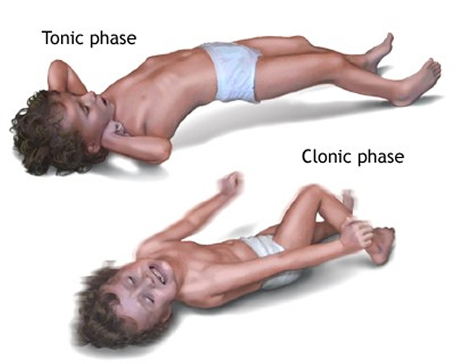 Тонические судороги у детей и клонические судороги