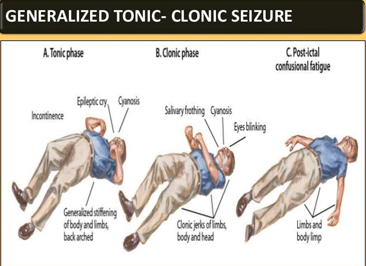 What Does A Petit Mal Seizure Feel Like