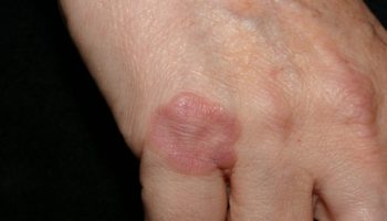 granuloma annulare