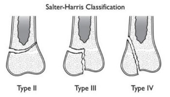 growth plate fracture