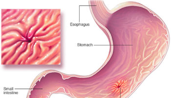 helicobacter pylori infection