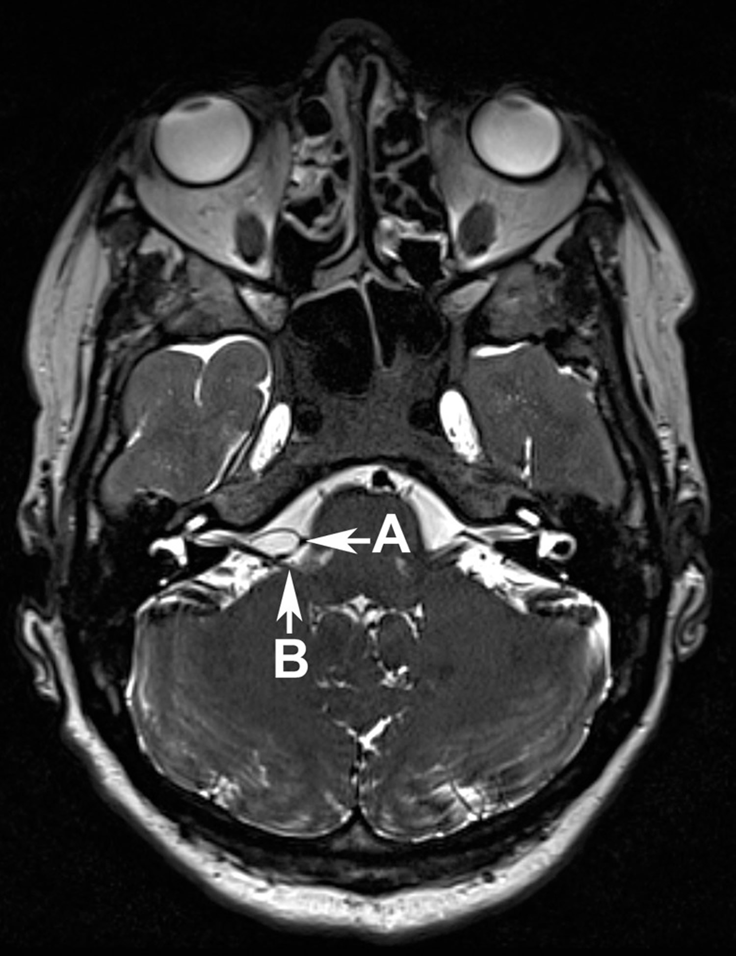 hemifacial-spasm-causes-symptoms-botox-surgery-treatment