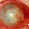 herpes keratitis