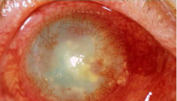herpes keratitis