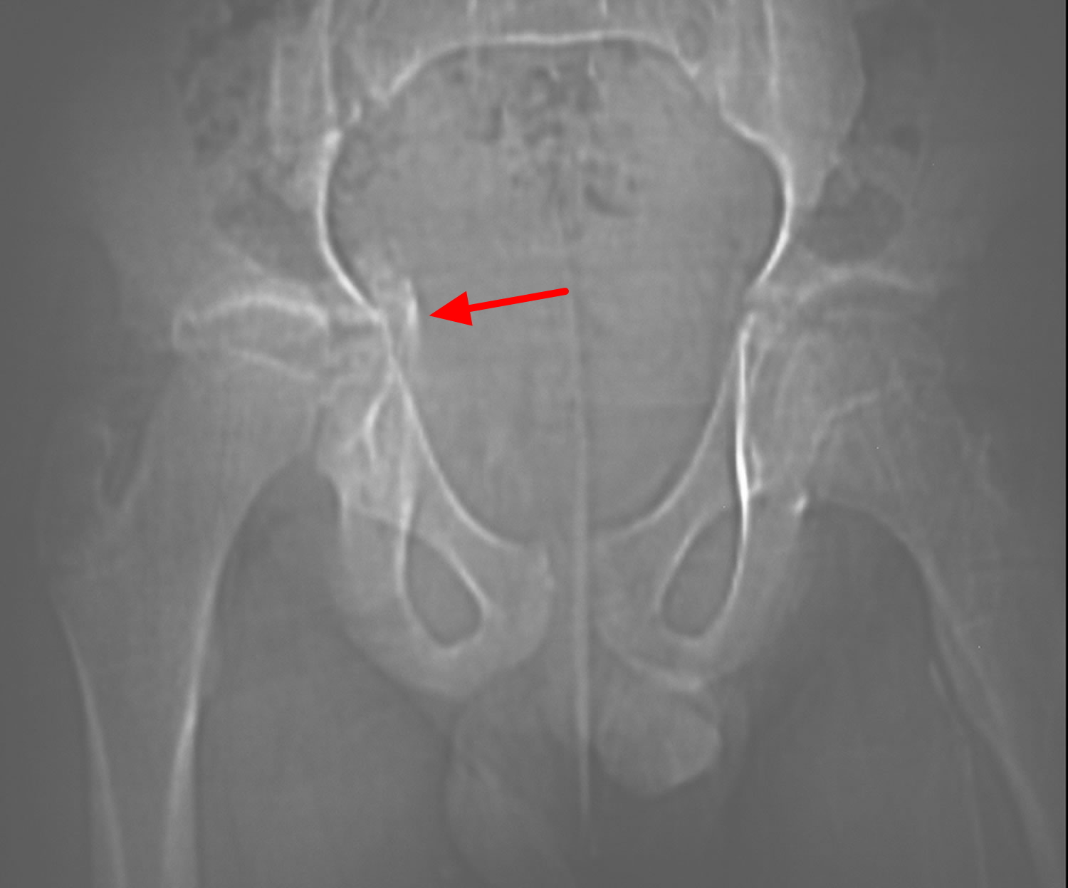 Hip Growth Plate Fracture