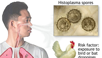 histoplasmosis