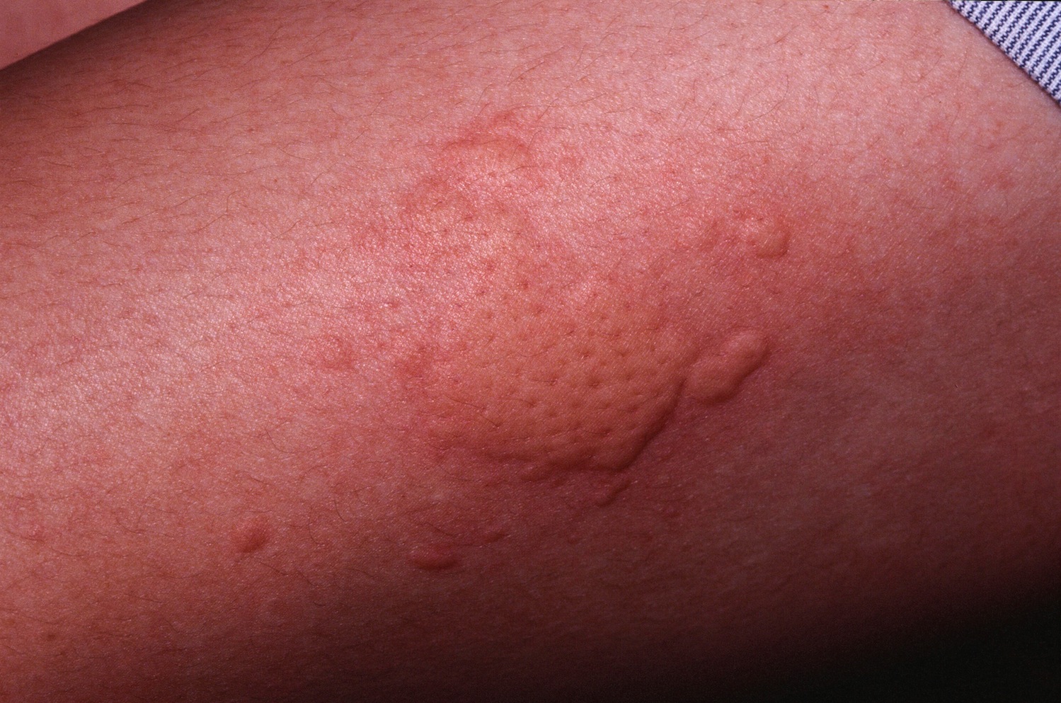 Chronic Hives Causes, Symptoms, and Treatment