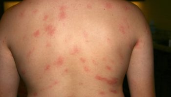 chronic hives