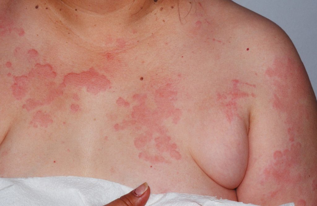 Chronic Hives Causes Symptoms And Treatment Gambaran 