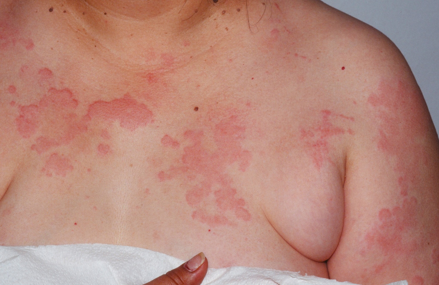 chronic-hives-causes-symptoms-and-treatment