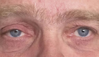 horner syndrome 1