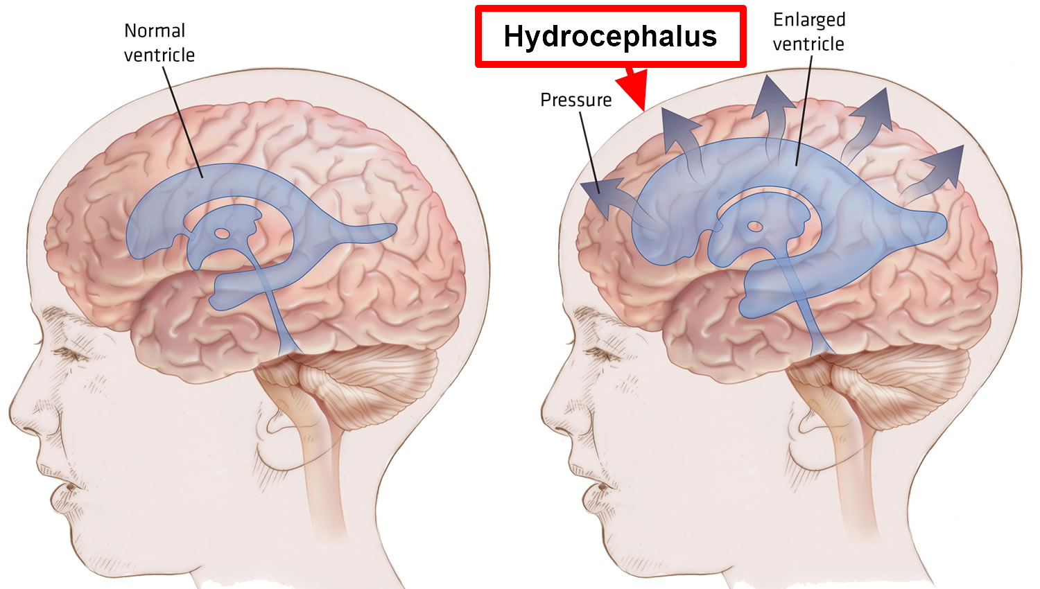 hydrocephalus after treatment