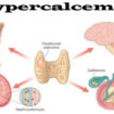 hypercalcemia
