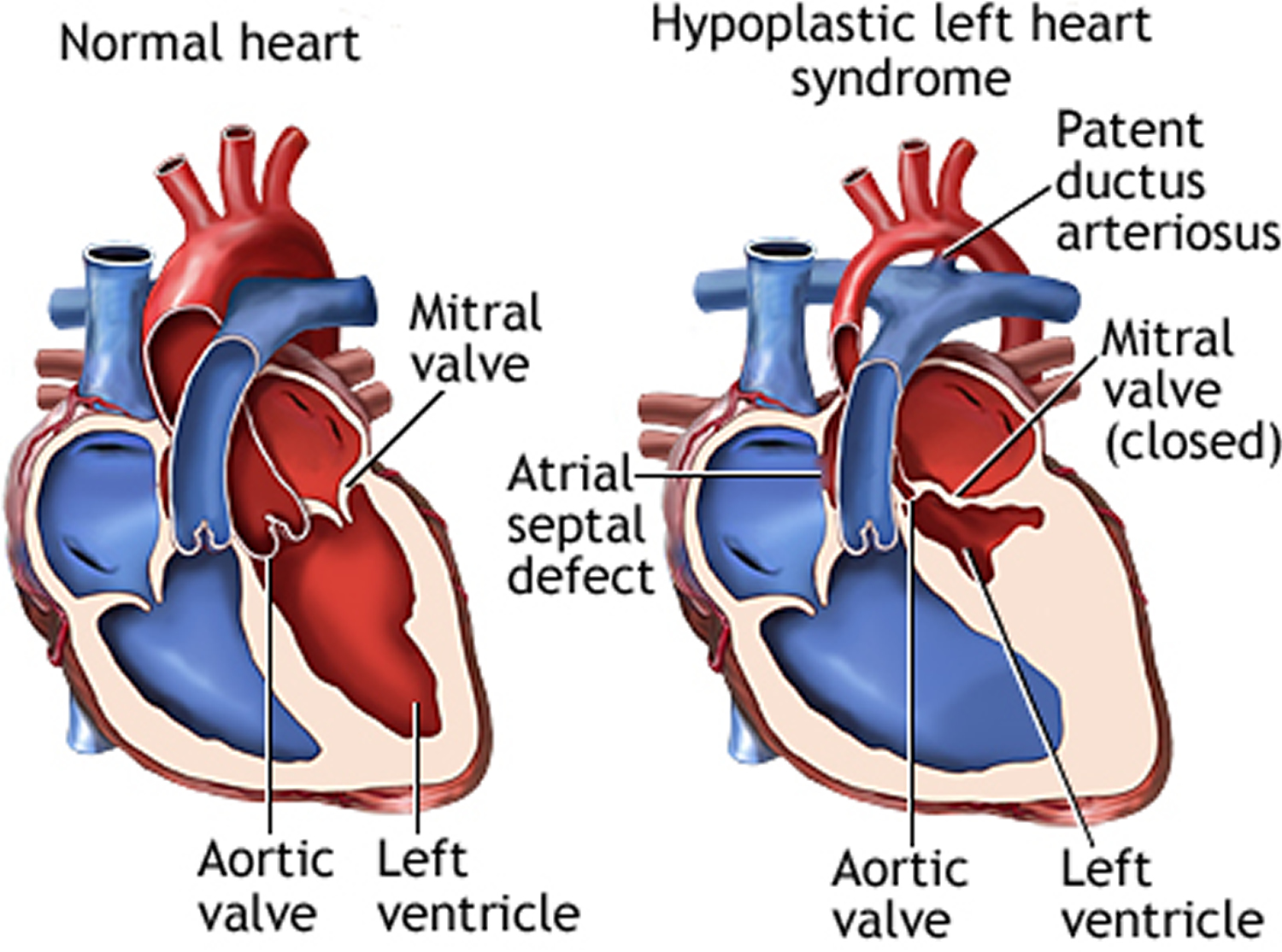 Hypoplastic Left Heart Syndrome Causes Prognosis Surgery Treatment