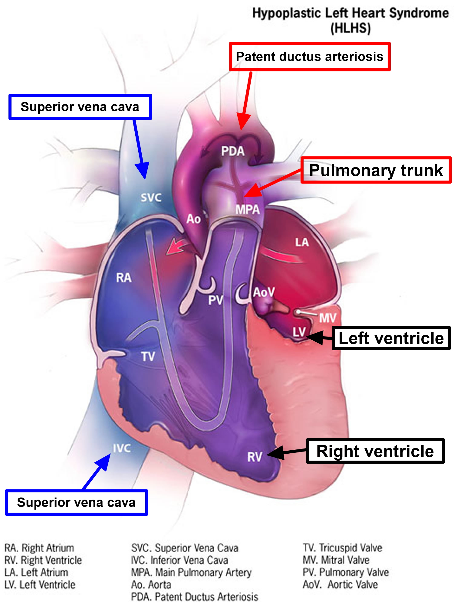 Hypoplastic Left Heart Syndrome Causes Prognosis Surgery Treatment