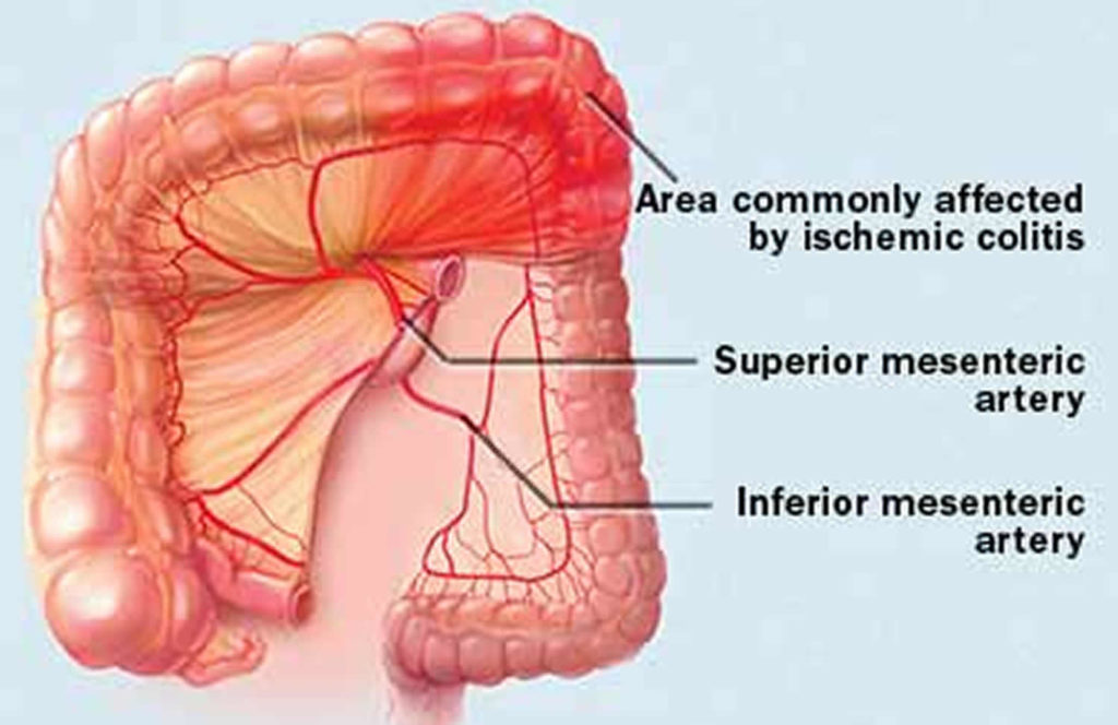 Ischemic Colitis Causes, Signs, Symptoms, Complications, Treatment