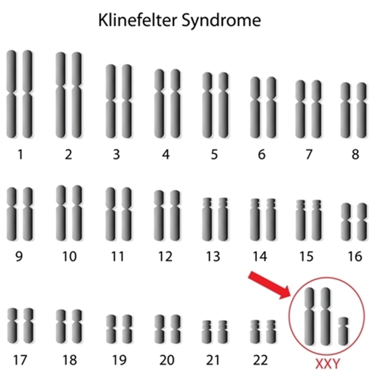 Klinefelter Syndrome Causes Karyotype Diagnosis Treatment 1267