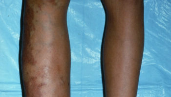 Klippel Trenaunay syndrome