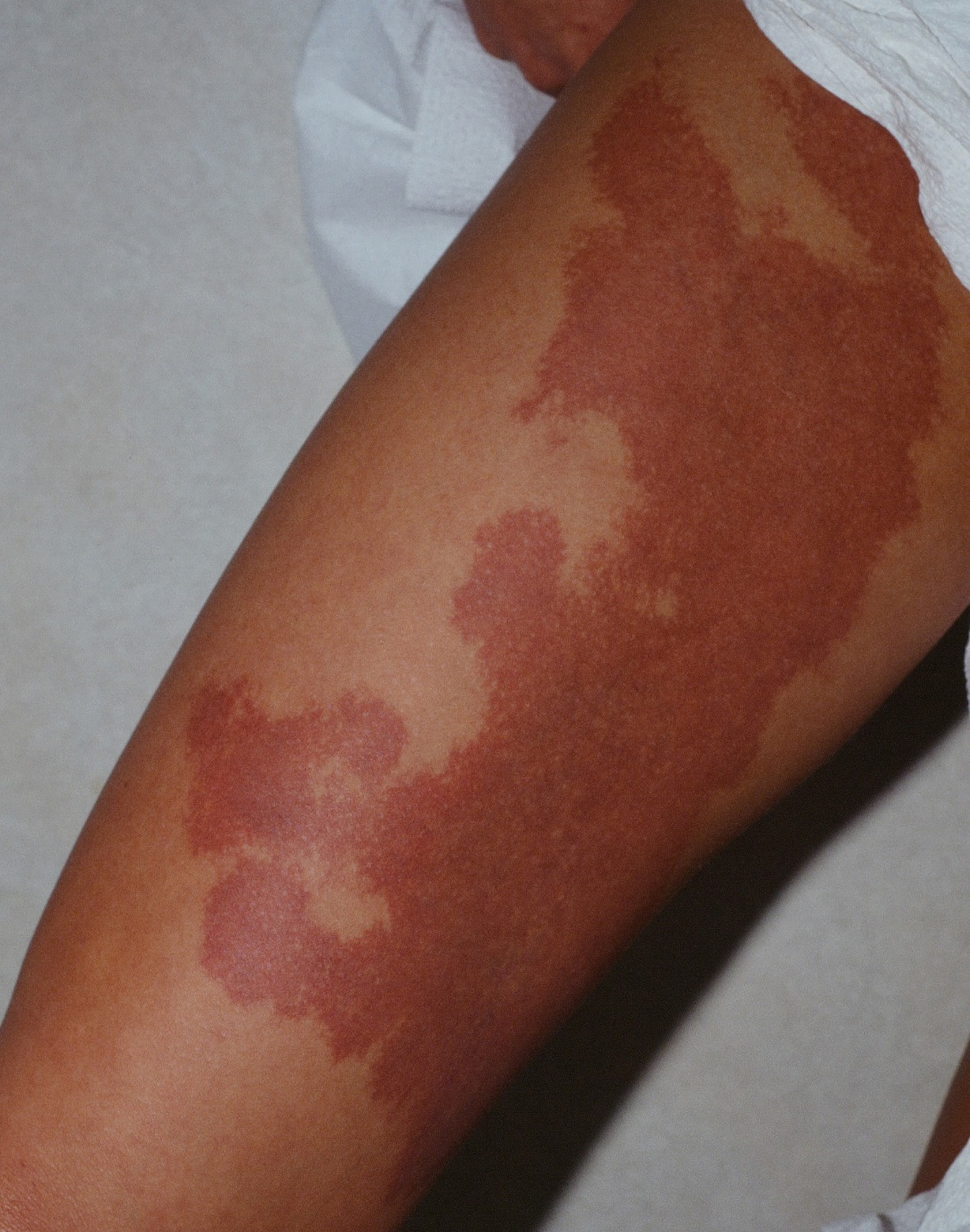 klippel trenaunay syndrome - port wine stain