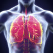 legionnaires disease