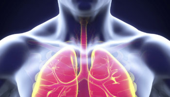 legionnaires disease