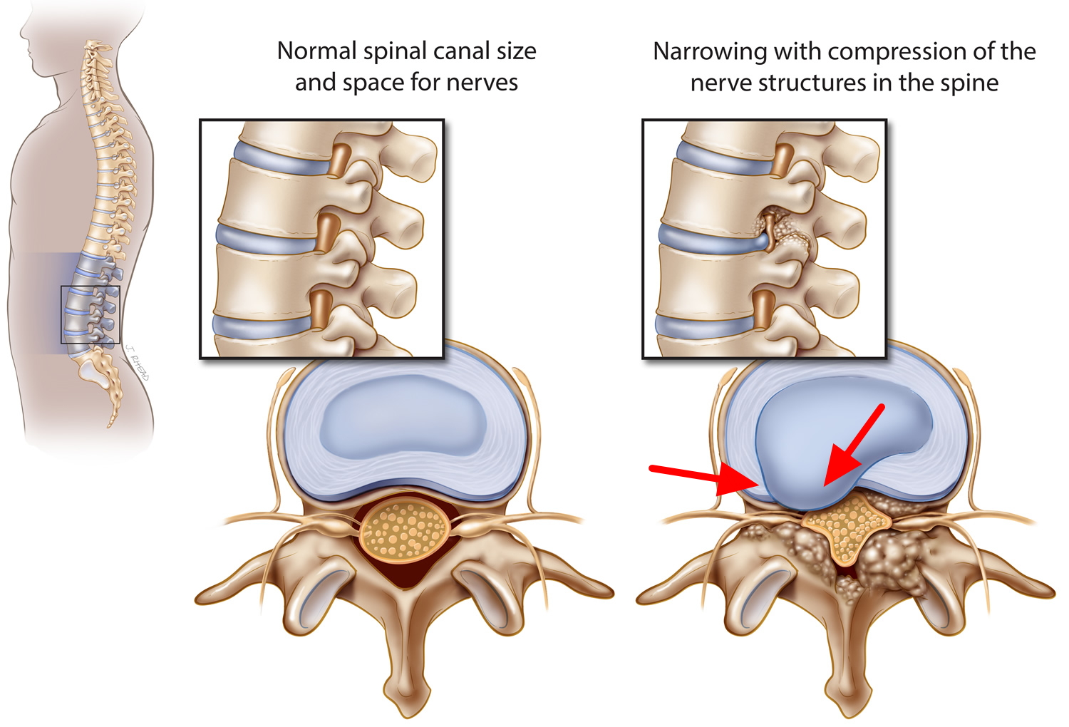 Spinal Stenosis Of Lumbar Region With Neurogenic Claudication