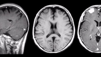 meningioma