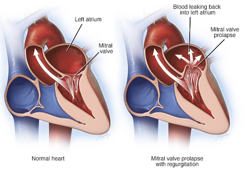 Mitral Valve Prolapse - Causes, Symptoms, Diagnosis, Treatment