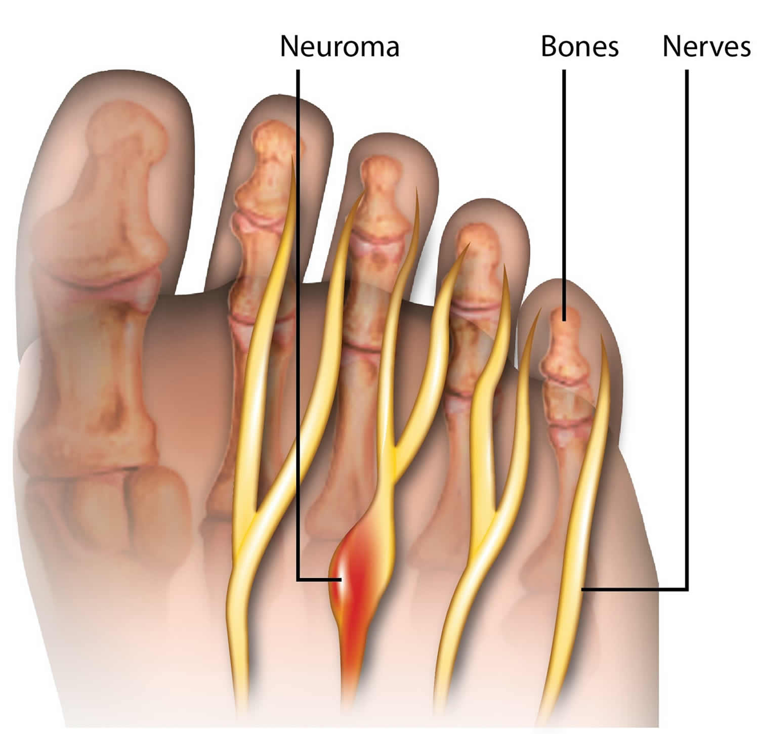 Morton s Neuroma Causes Symptoms Diagnosis Treatment