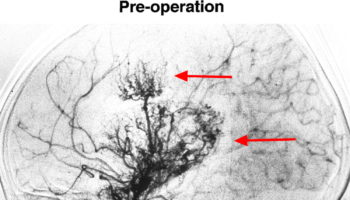 moyamoya disease