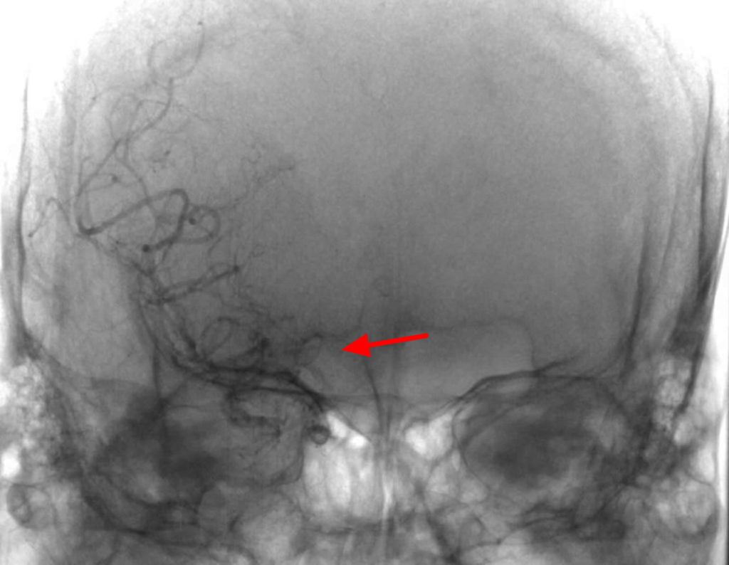Moyamoya Disease Causes, Symptoms, Life Expectancy, Treatment