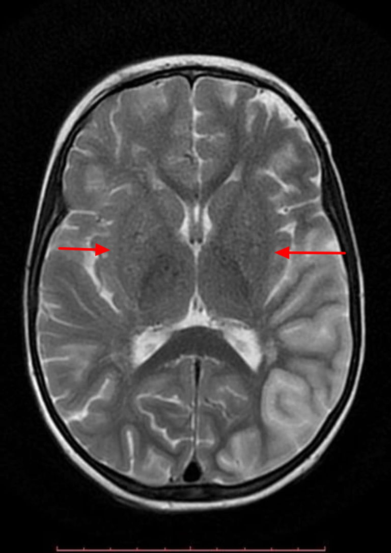 Moyamoya Disease Causes, Symptoms, Life Expectancy, Treatment