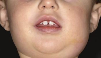 mumps