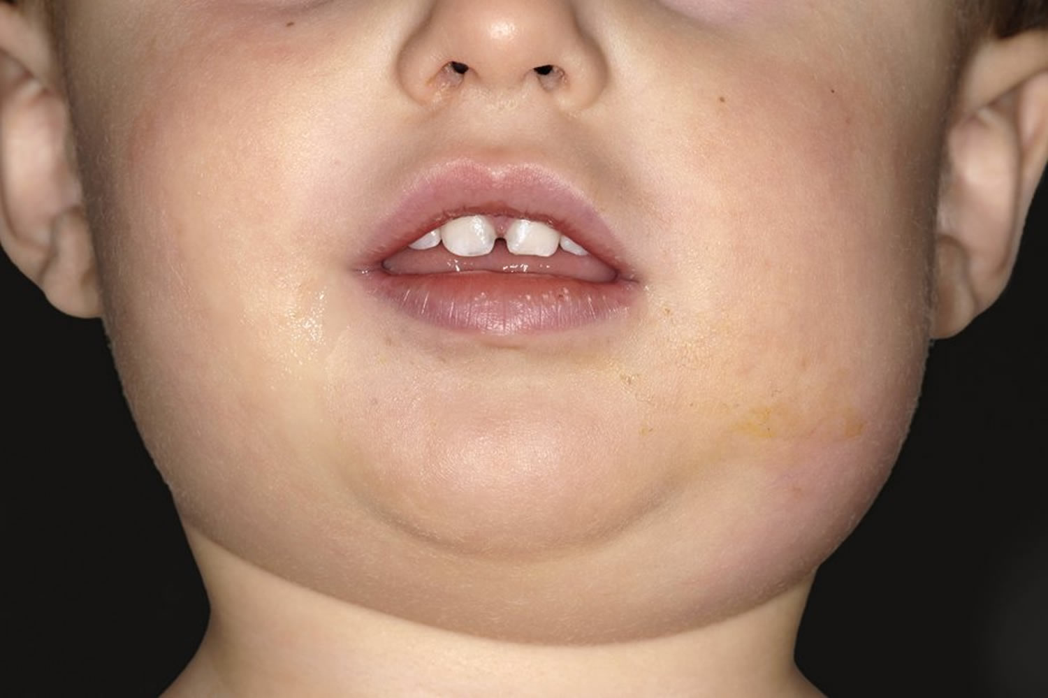 Mumps Symptoms What Mumps Look Like Vaccine Treatment