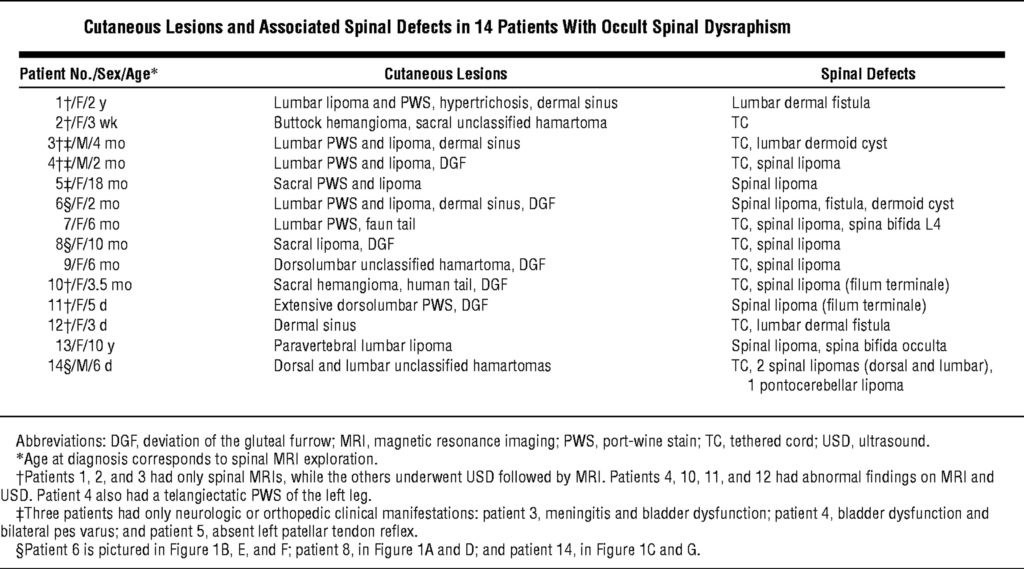 Sacral Dimple Causes, Newborn, Adults, Ultrasound & Management