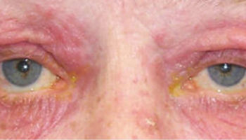 ocular-rosacea