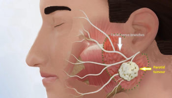 parotid tumor