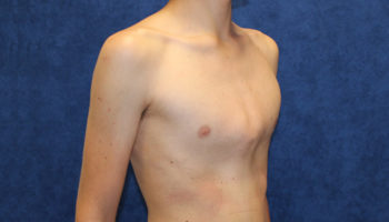 pectus carinatum