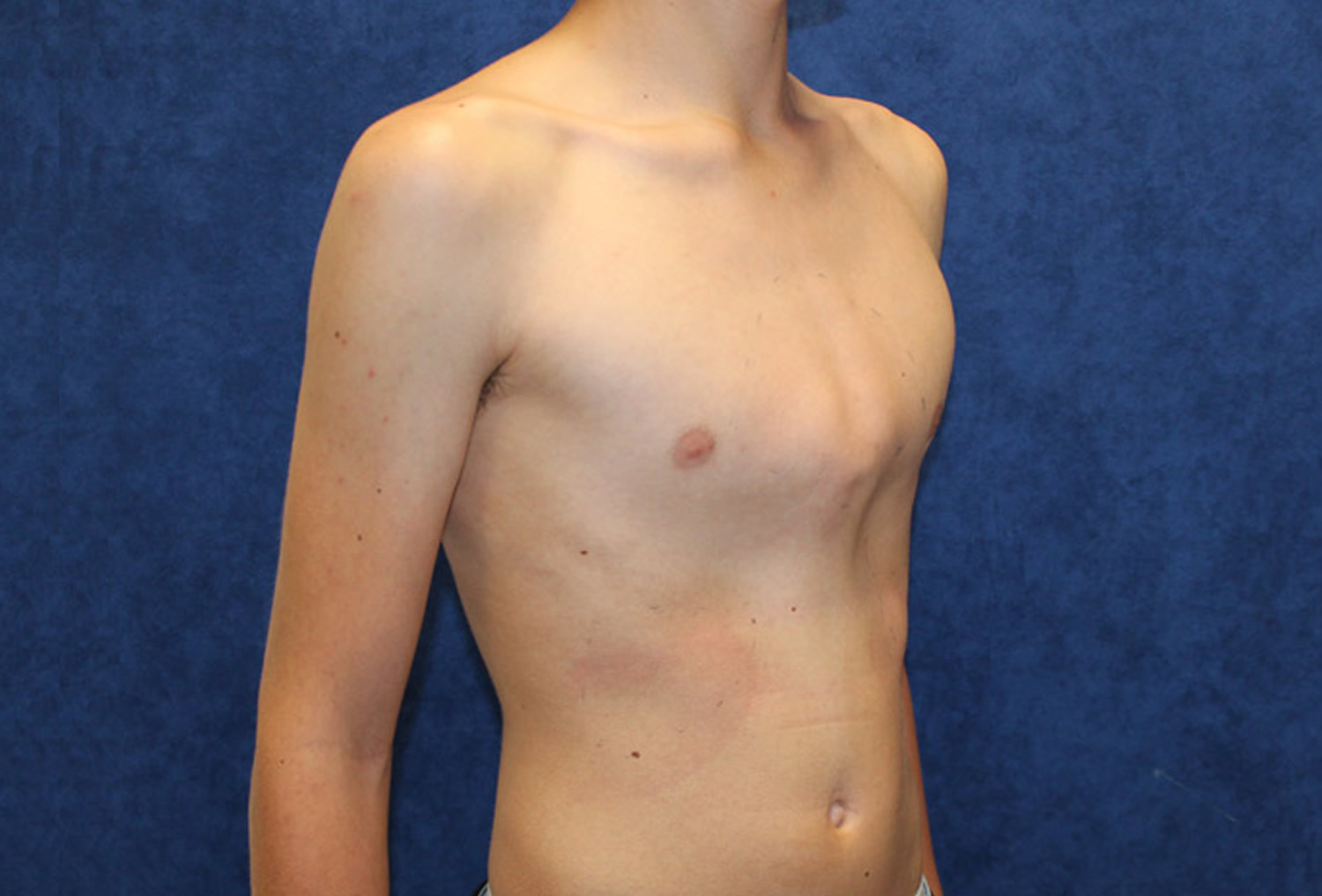 Pectus carinatum. 