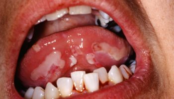 pemphigus vulgaris