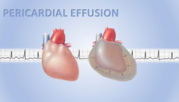 pericardial effusion