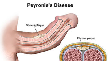 peyronie’s disease
