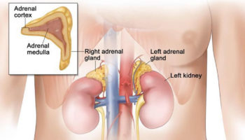 pheochromocytoma
