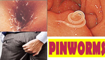 pinworm infection
