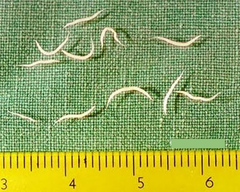 Pinworm Infection - Symptoms, Anus, Diagnosis, Treatment